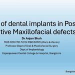 role of dental implants in post ablative maxillofacial defects