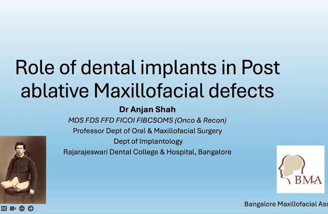 Session #07 Role of Dental Implants in Post Ablative Maxillofacial Defects